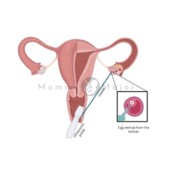 in vitro fertilization