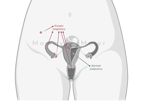ectopic pregnancy