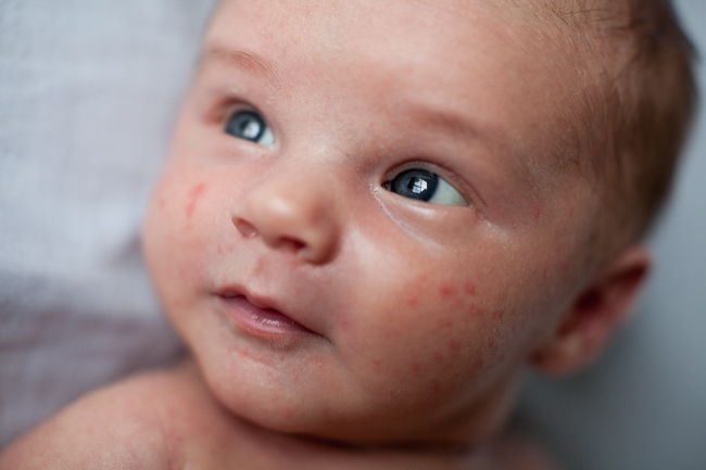 Baby acne on the face