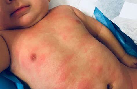 Baby eczema on the body