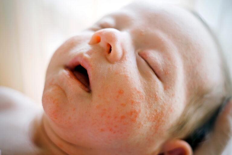 neonatal acne